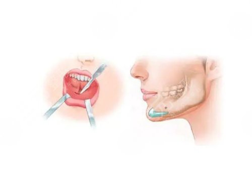 下頜骨歪了怎么矯正