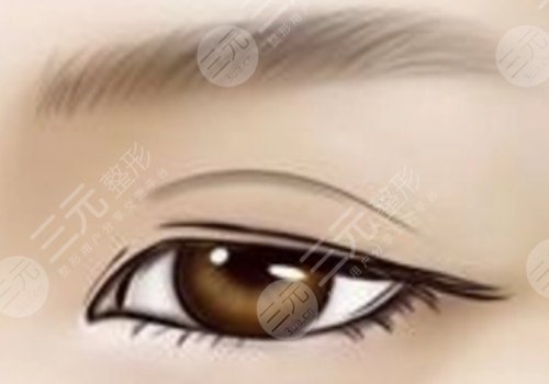 雙眼皮修復(fù)是不是重新做一次