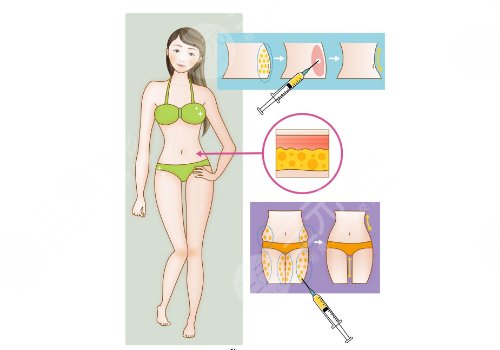 大腿部吸脂減肥怎么樣
