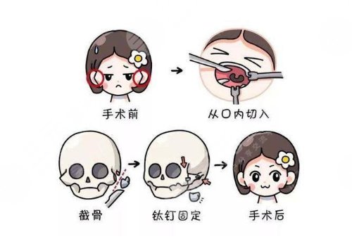 下頜骨削骨手術(shù)多少錢