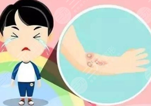 成都市第二人民醫(yī)院祛疤怎么樣