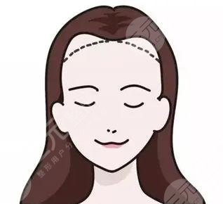 發(fā)際線種植