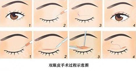 米蘭許智醫(yī)生雙眼皮怎么樣