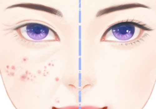 縮小毛孔的醫(yī)美項目