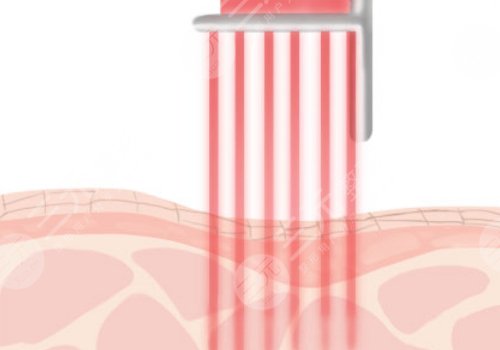 縮小毛孔的醫(yī)美項目