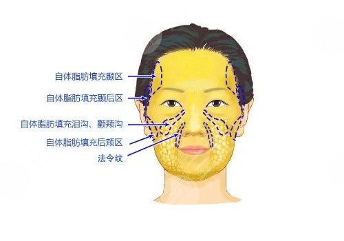 脂肪填充能維持幾年