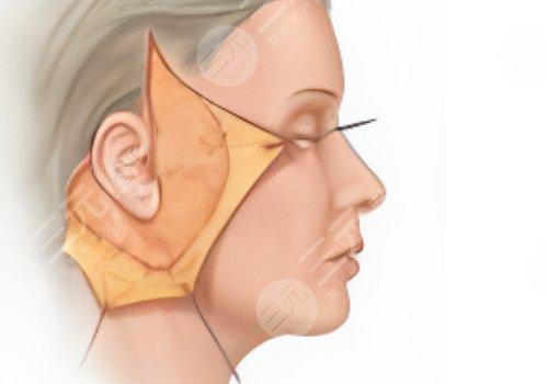做拉皮手術(shù)能保持多少年