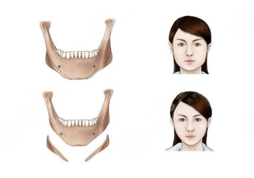 下頜骨整形術(shù)一般費用