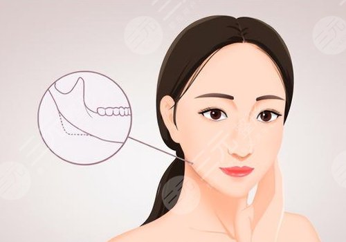 下頜角磨骨手術(shù)風(fēng)險(xiǎn)大嗎