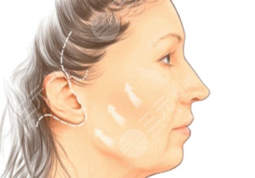 面部下垂好的醫(yī)美手段