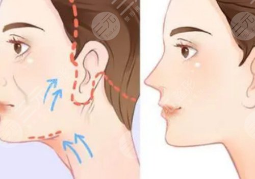 面部下垂好的醫(yī)美手段
