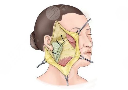 面部下垂好的醫(yī)美手段
