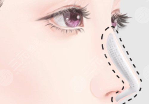 隆鼻想長久建議硅膠還是膨體