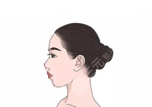 下頜骨后縮怎么矯正