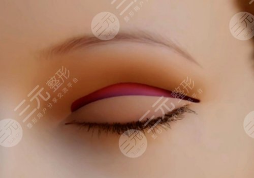 曹麗紅總醫(yī)院雙眼皮手術(shù)案例