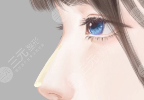 假體隆鼻可以維持多少年