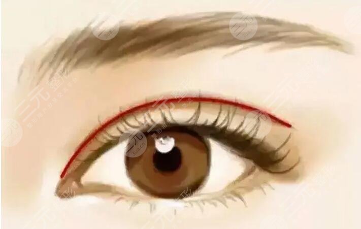 開(kāi)內(nèi)眼角