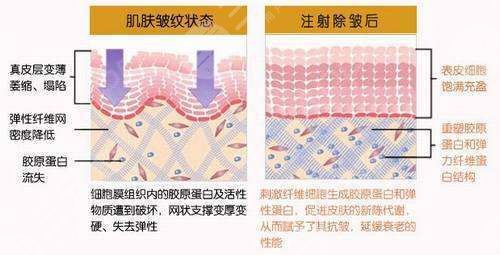 法思麗玻尿酸屬于什么檔次?