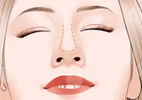 肖文明做鼻子怎么樣