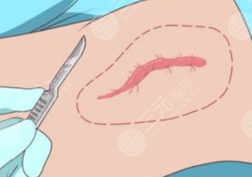 蘇州附二院祛疤怎么樣