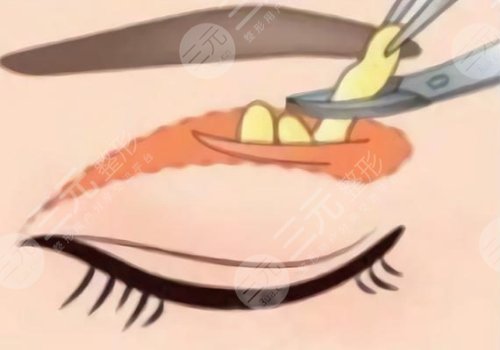 恢復(fù)快的雙眼皮做法是什么