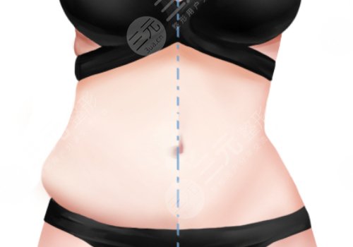 腰部環(huán)形吸脂手術(shù)大概多少錢