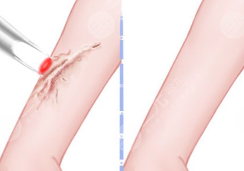 蘇州附二院祛疤多少錢