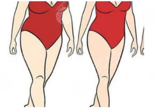 腰腹吸脂多久可以側(cè)身睡覺