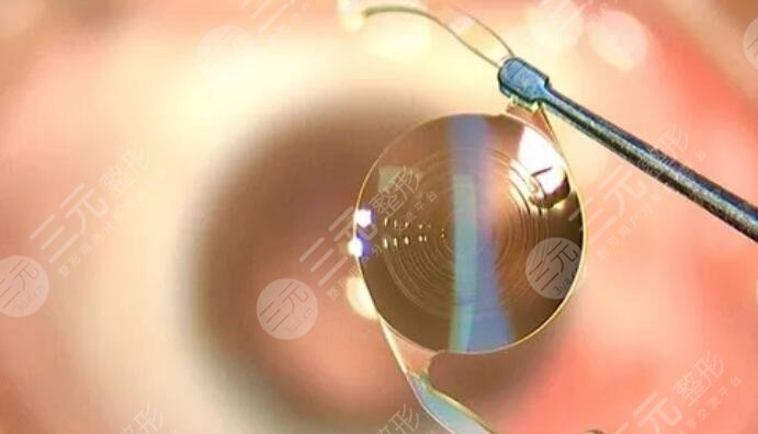 白內(nèi)障晶體植入
