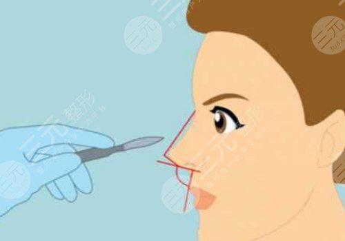 隆鼻膨體價格一般要多少