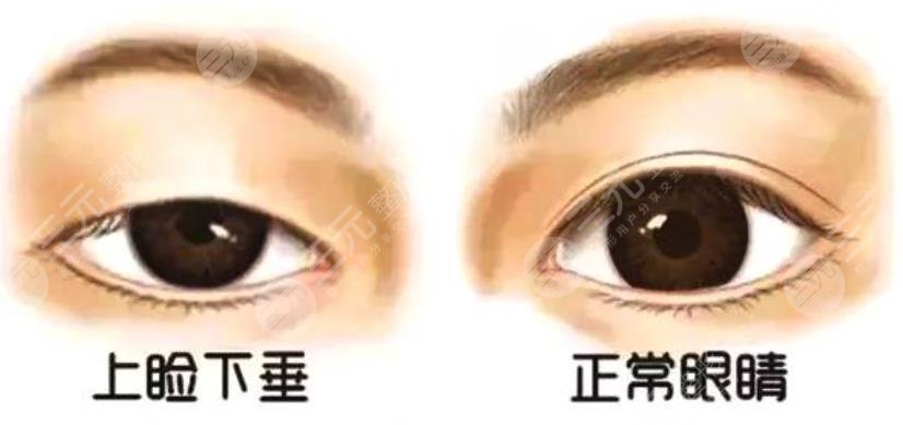 上瞼下垂術(shù)