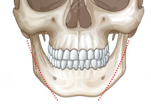下頜骨歪斜怎么矯正