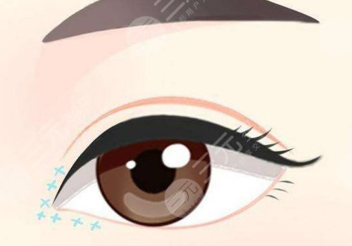 埋線雙眼皮一個寬一個窄怎么修復