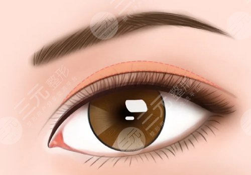 埋線雙眼皮一個寬一個窄怎么修復