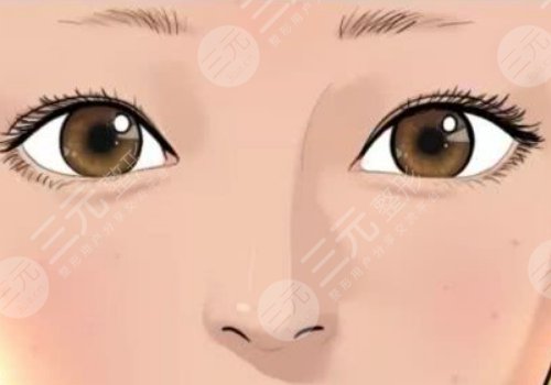 割雙眼皮第七天恢復(fù)圖