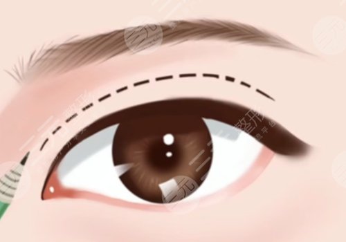 雙眼皮修復(fù)術(shù)后護(hù)理