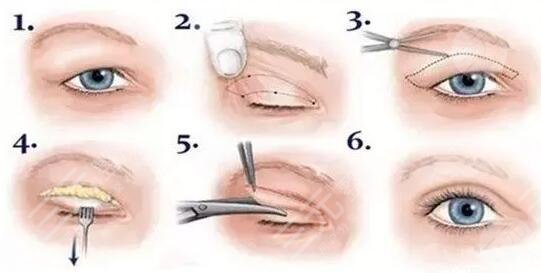 雙眼皮手術(shù)