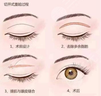 李桂珍醫(yī)生做雙眼皮價(jià)格參考