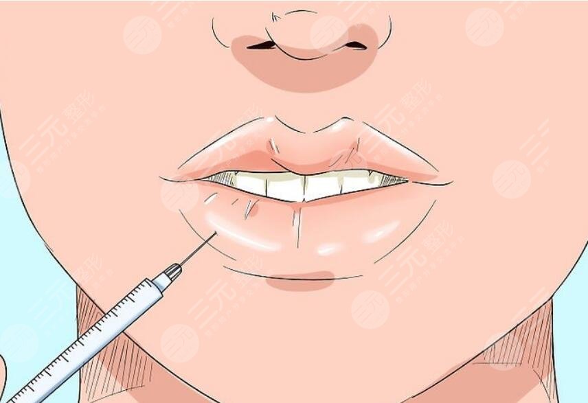 豐唇手術(shù)