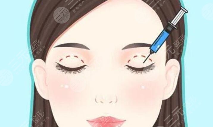 雙眼皮手術(shù)