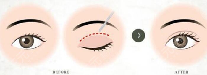 雙眼皮手術(shù)