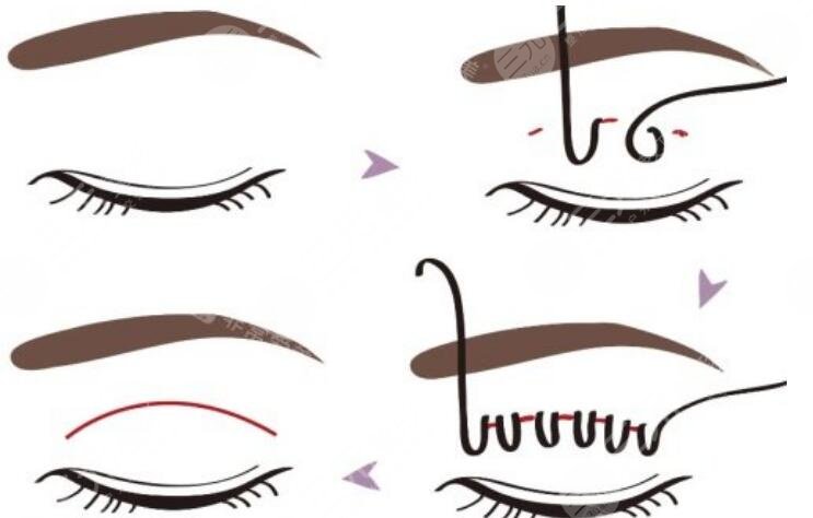 雙眼皮手術(shù)