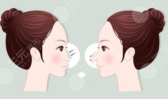 鼻畸形矯正項目