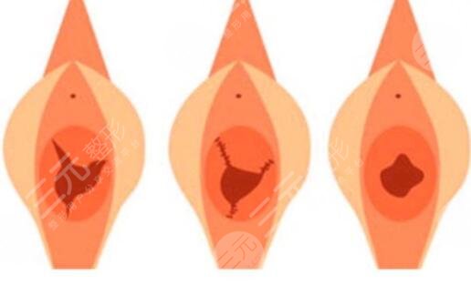 處女膜修復(fù)