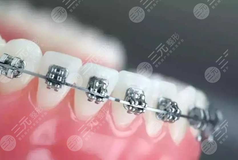 牙齒矯正