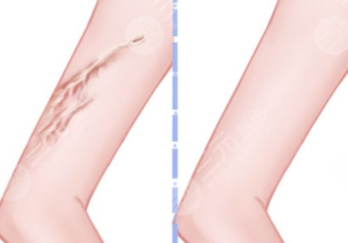 章一新疤痕怎么樣