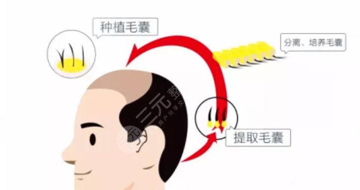 植發(fā)手術(shù)