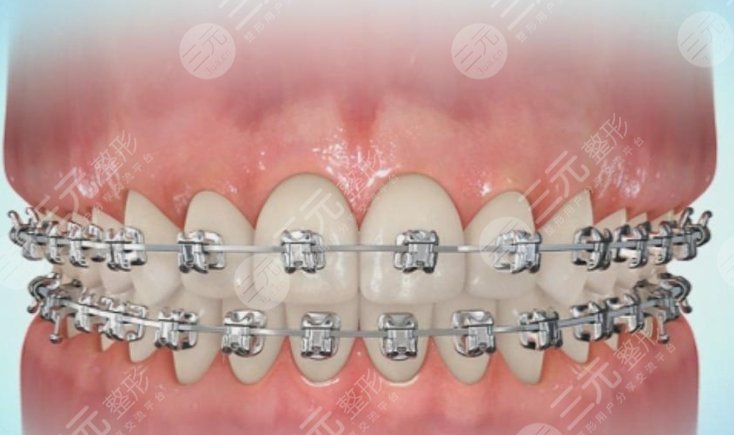 牙齒矯正
