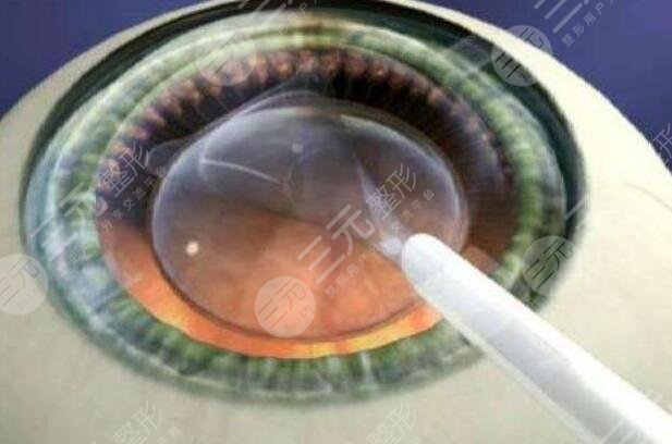 準(zhǔn)分子激光近視矯正