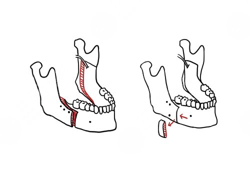 南方醫(yī)院正頜手術(shù)費用需要多少